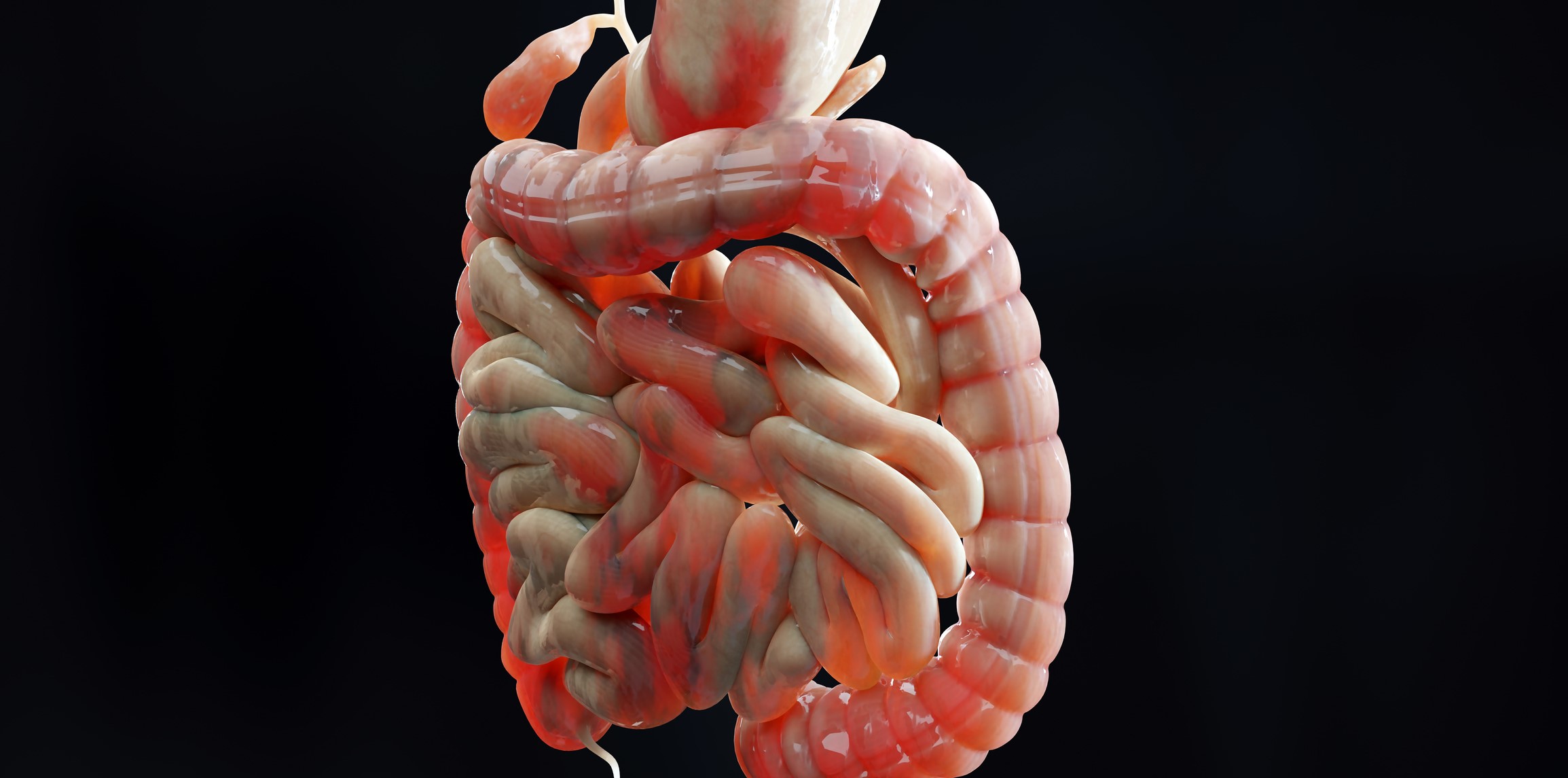 Man suffering from crohns disease, male anatomy, inflamed large intestine, Sigmoid Colon, human digestive system parts, 3d render graphic image, gastroenterology