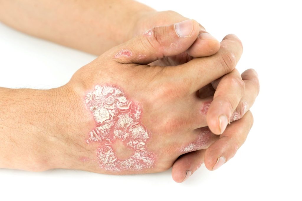 Plaque psoriasis, psoriasis vulgaris on male hands with plaque, rash and patches, dermatology, photo