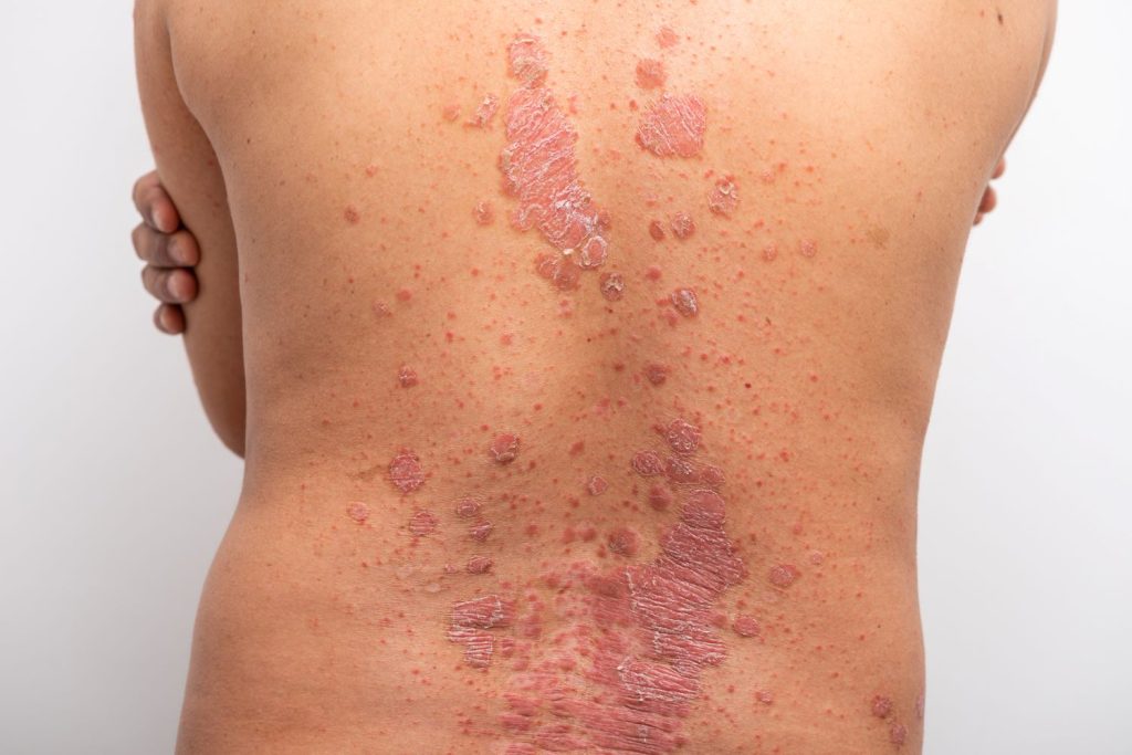 Psoriasis on a person's back on white background, dermatology, photo