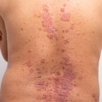 Psoriasis on a person's back on white background, dermatology, photo