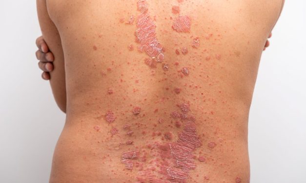 Exploring Secukinumab’s Effectiveness and Safety in Psoriasis Treatment