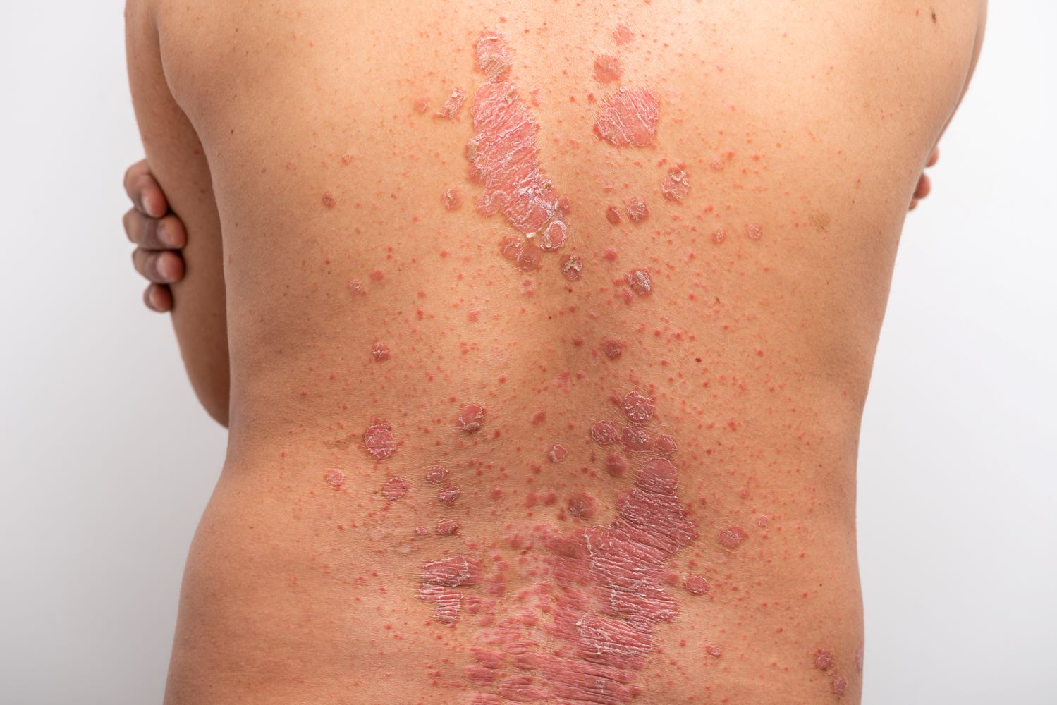 Exploring Secukinumab's Effectiveness and Safety in Psoriasis Treatment