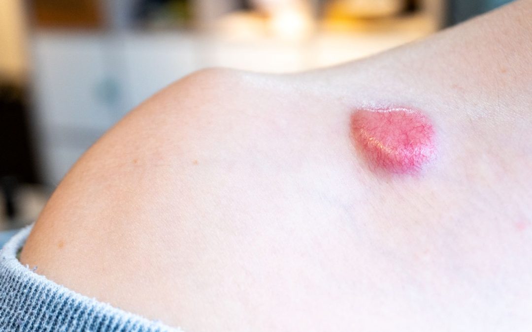 Nonmelanoma Skin Cancers Tied to Lower Extremity Lymphedema