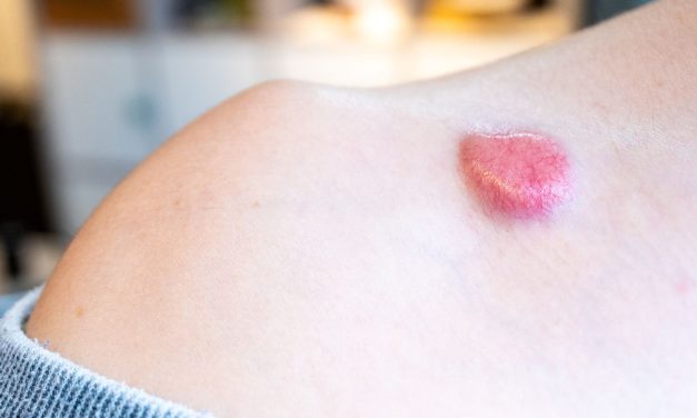 Nonmelanoma Skin Cancers Tied to Lower Extremity Lymphedema