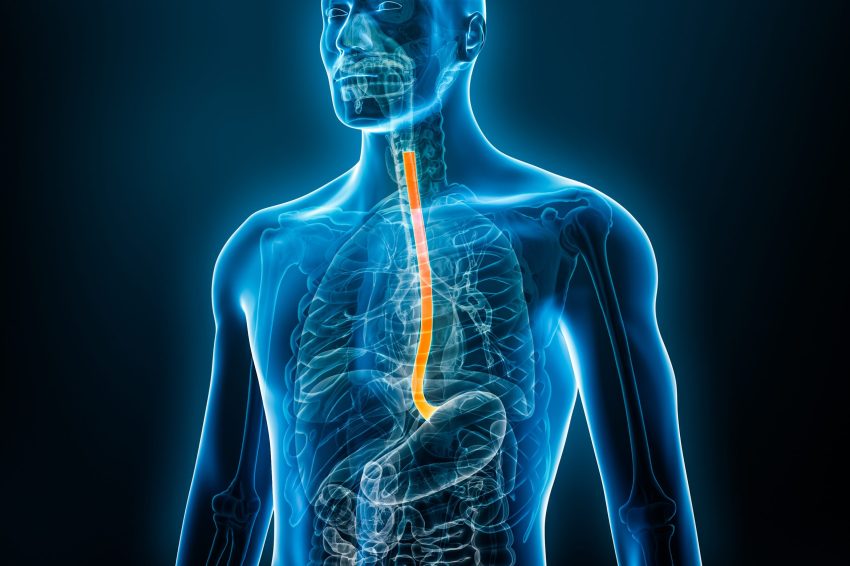 The role of transoral incisionless fundoplication (TIF) in the management of gastroesophageal reflux disease (GERD) following peroral endoscopic myotomy (POEM): A pilot, prospective, patient-driven study.