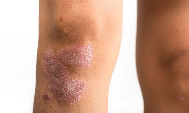 Biological Agent Trials for Psoriasis Rarely Include Patient Images