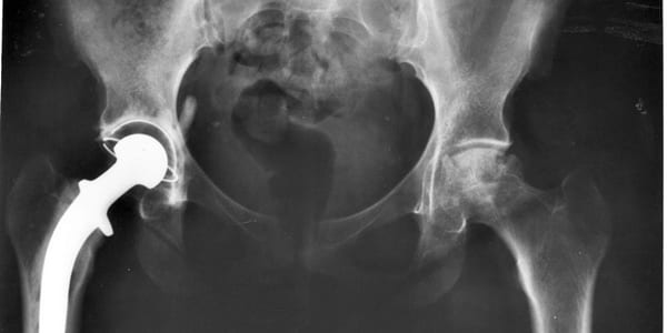 Low mental health may be associated with poor clinical outcomes following total hip arthroplasty