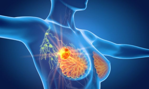 Clinical Breast Exam Rarely Detects Second Breast Cancer After DCIS