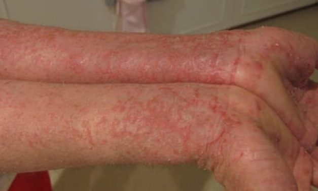 IL-23 inhibitors may have a lower risk of paradoxical eczema in comparison to other biologics