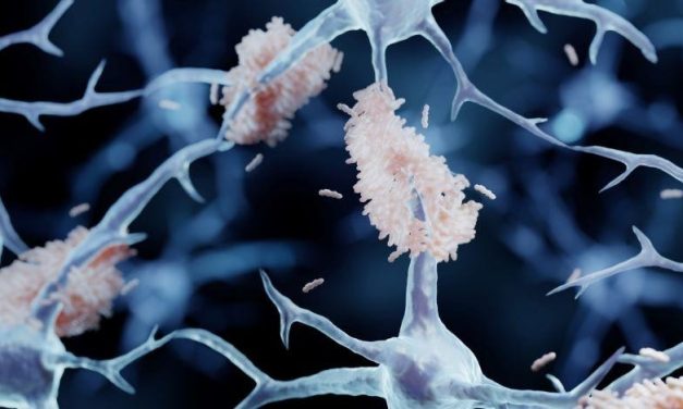 Monoclonal Antibodies Provide Small Benefits in Alzheimer Disease