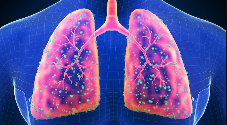 Chronic Lung Disease
