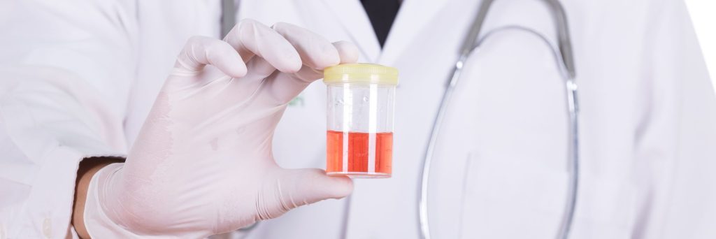 Doctor's hand holding a bottle of bloody urine sample, hematuria, urology, photo