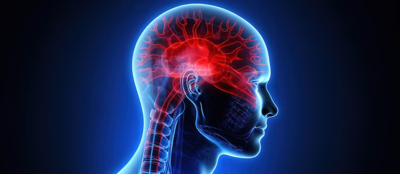 Exploring Postdromal Symptoms in Migraine
