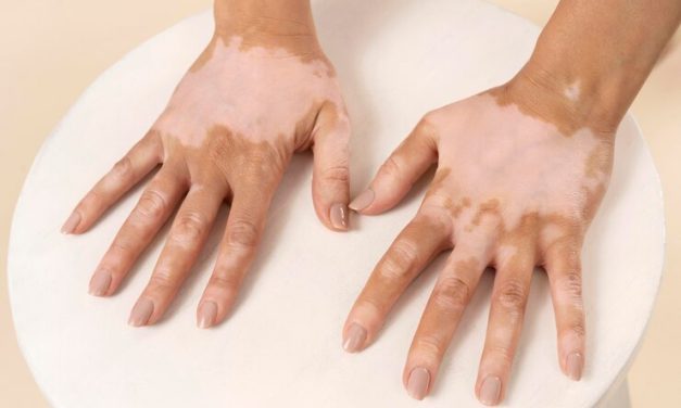 Risk for Vitiligo Increased for Transplant Recipients
