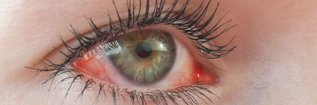 Red irritated human eye close up, allergy, bloodshot, eye stroke, ophthalmology, photo