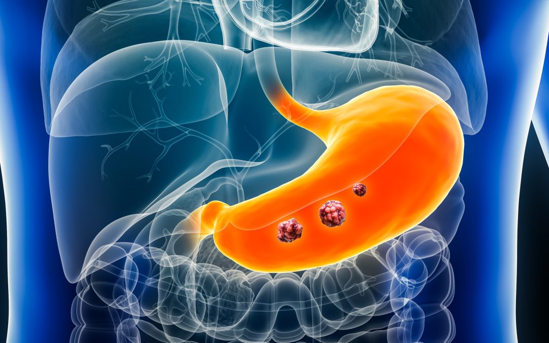 FLOT Plus Durvalumab Leads to High pCR Rate in Gastric Cancer