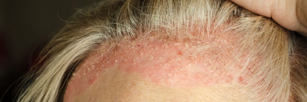 Dermatological skin disease. psoriasis, eczema, dermatitis, allergies. Skin lesions, scalp.