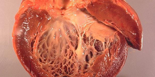 Acoramidis slows disease progression in transthyretin amyloid cardiomyopathy
