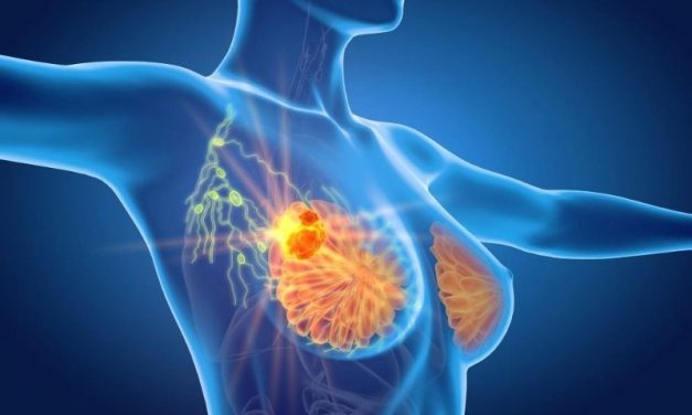 Low-Dose Positron Emission Mammography Helps ID Breast Cancer