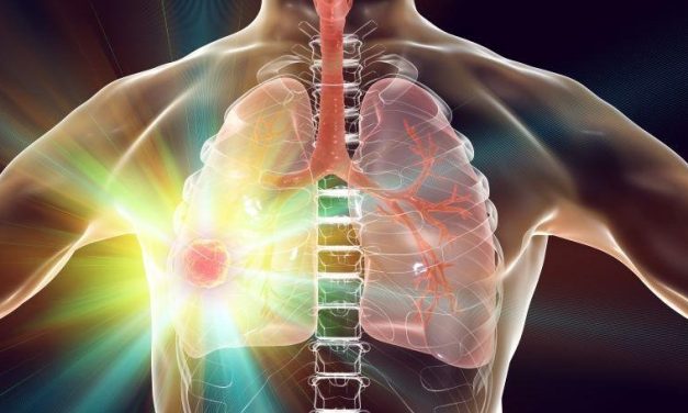 Tislelizumab Plus Chemotherapy Beneficial for Resectable NSCLC