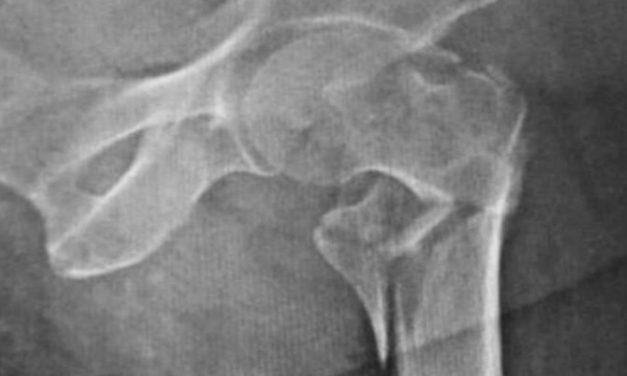 Use of direct oral anticoagulants should not delay surgical intervention for patients with hip fractures