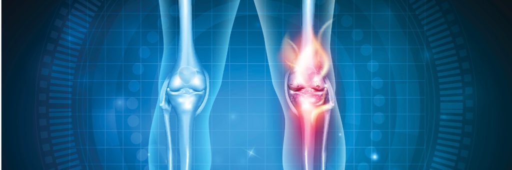 osteoarthritis, Knee pain