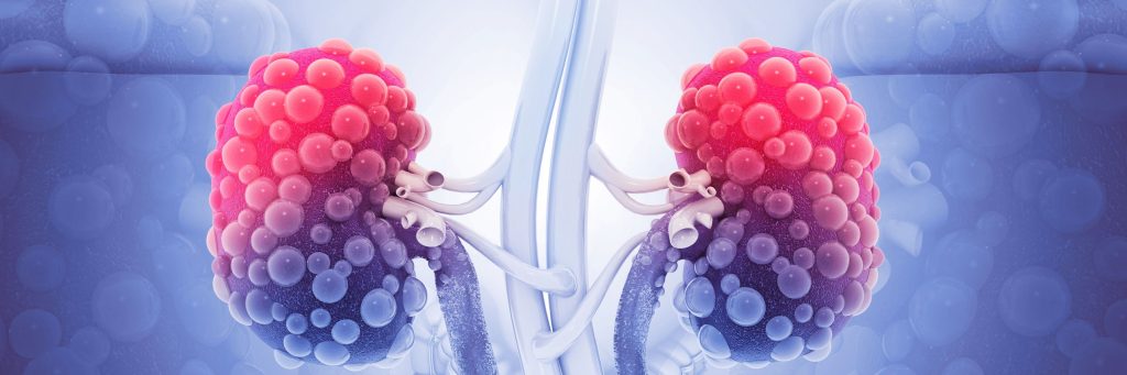 polycistic kidney disease closeup, nephrology, graphic image