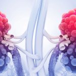 polycistic kidney disease closeup, nephrology, graphic image