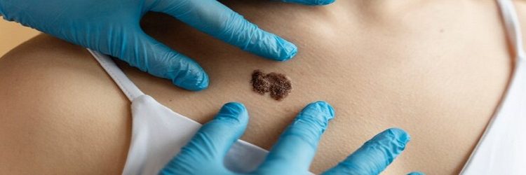 Analyzing the Link Between Melanoma Survival and Dermatologic Follow-up