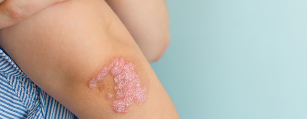 CVD Exams Important in Moderate-to-Severe Psoriasis