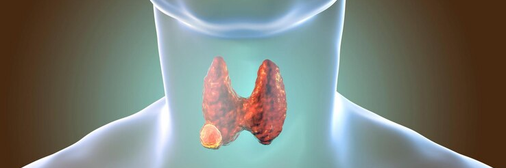 Analyzing Genetic Changes Linked with Radioiodine Avidity in Metastatic Thyroid Cancer