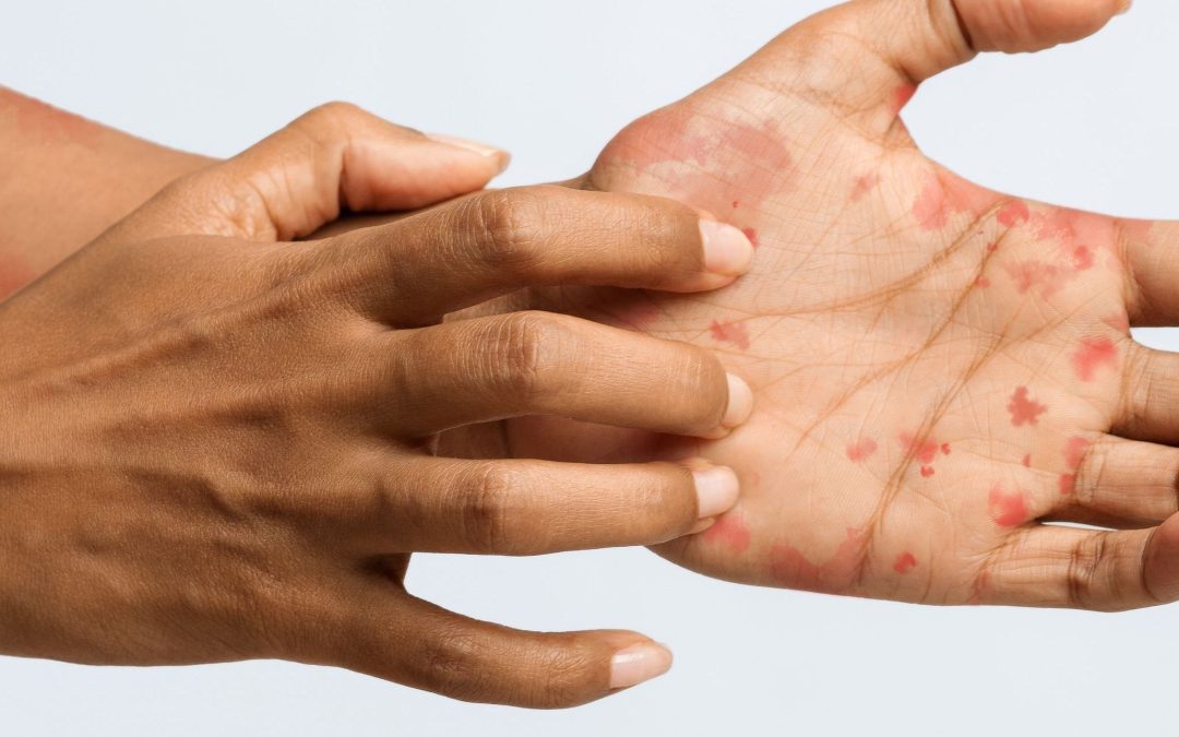 Patient Race Not Associated With Charlson Comorbidity Index Scores in Psoriasis