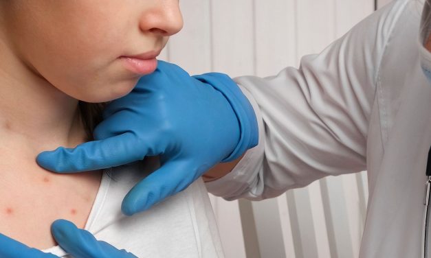 U.S. Measles Cases Reach 125, Surpassing Recent Peak in 2022