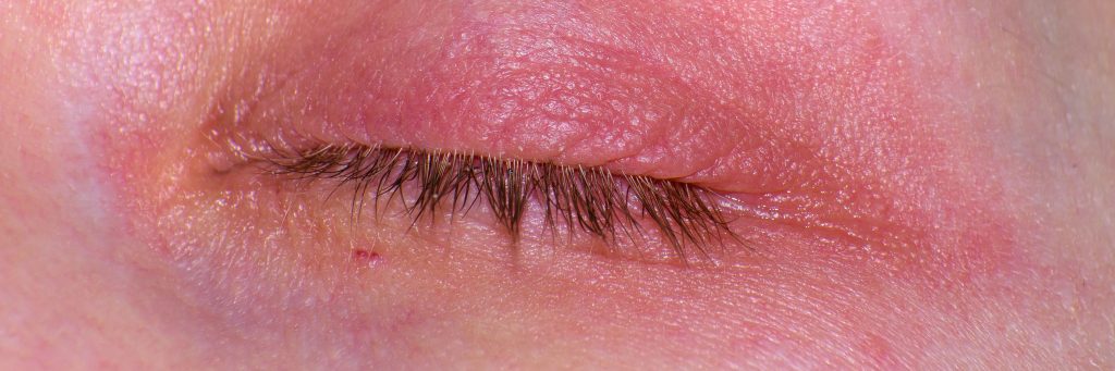 Itchy eyelid rash, atopic dermatitis, dermamytosis, closeup