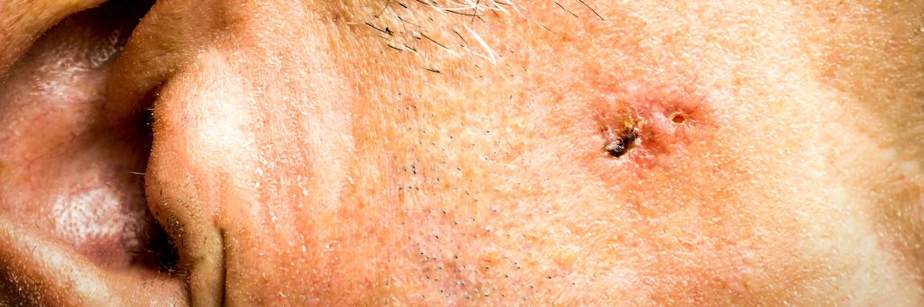 closeup Basal Cell Carcinoma on the face of older man