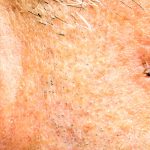 closeup Basal Cell Carcinoma on the face of older man
