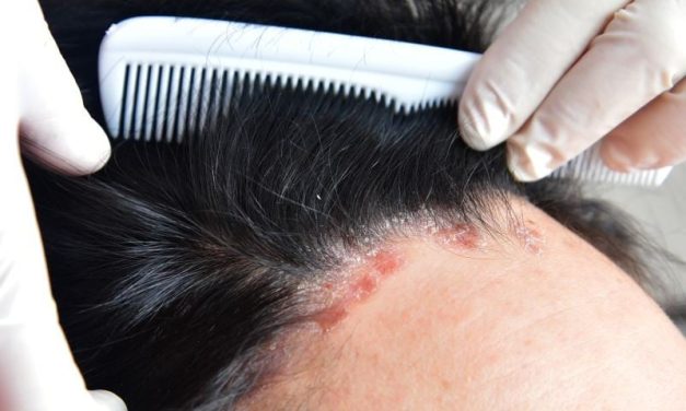 Tacrolimus Microemulsion Has Good Efficacy, Safety for Scalp Psoriasis