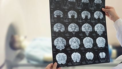 Overall Stroke Rates Down, but Hemorrhagic Stroke Up in Recent Years