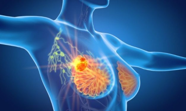 Ribociclib + Nonsteroidal Aromatase Inhibitor Benefits Early Breast Cancer