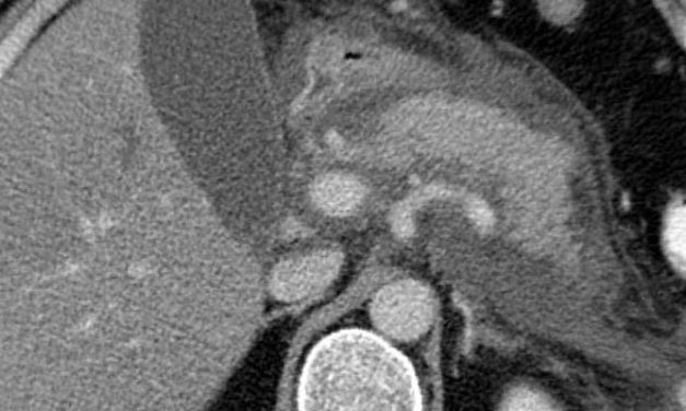 Prophylactic pancreatic stent plus indomethacin reduces rates of pancreatitis following endoscopic retrograde cholangiopancreatography