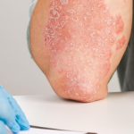 Caveolae-Linked Proteins in Psoriasis