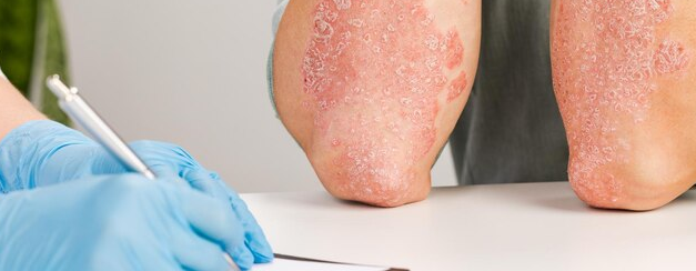 Psoriasis Biologics Safe in Patients With Cancer