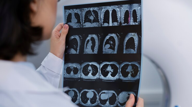 Lung Nodule Detection in CT Scans