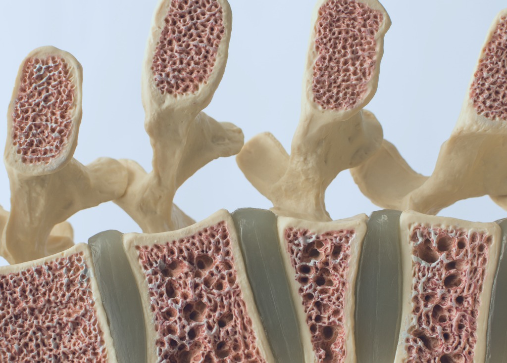 A close-up model of the human spine on a white background showing various defects in the bones and vertebrae. From top to bottom: normal vertebral bone, osteoporotic bone, wedge fracture, compression fracture.