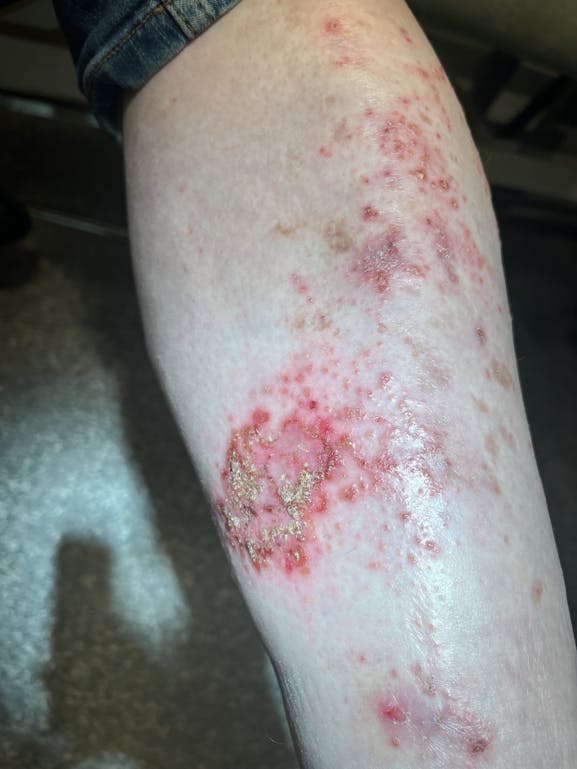 Skin Rash Presentation in Patient With UC