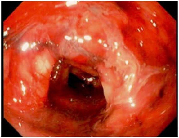 Ischemic Colitis With COVID-19