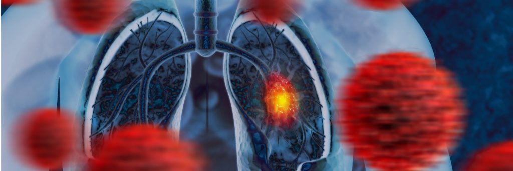 Cancer cells infected the Human Respiratory System, lungs, NSCLC