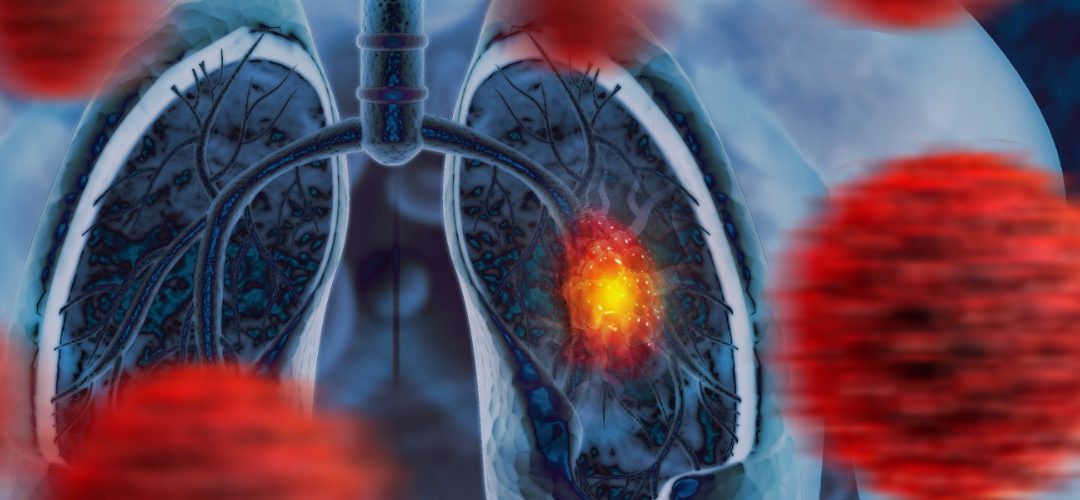 Thoracoscopic Lobectomy Superior to Open Surgery for NSCLC After Neoadjuvant Therapy