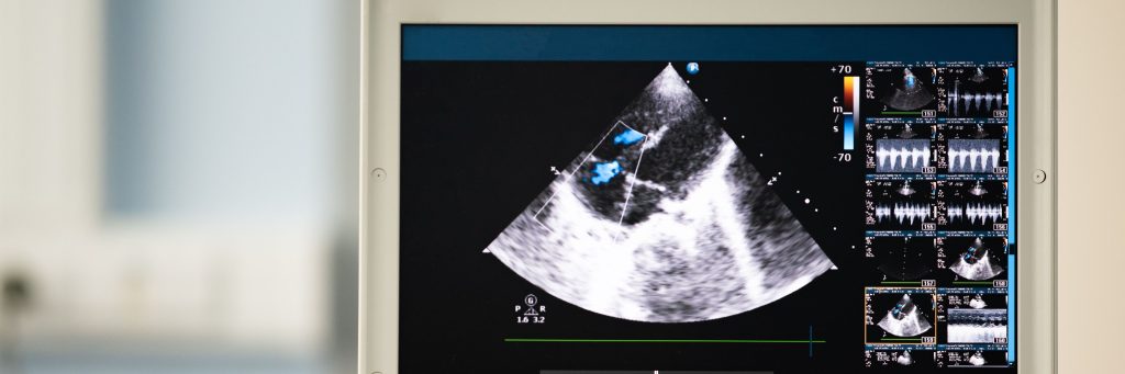 On the ultrasound screen, the image of the heart in the four-chamber position and the Doppler method shows tricuspid regurgitation.