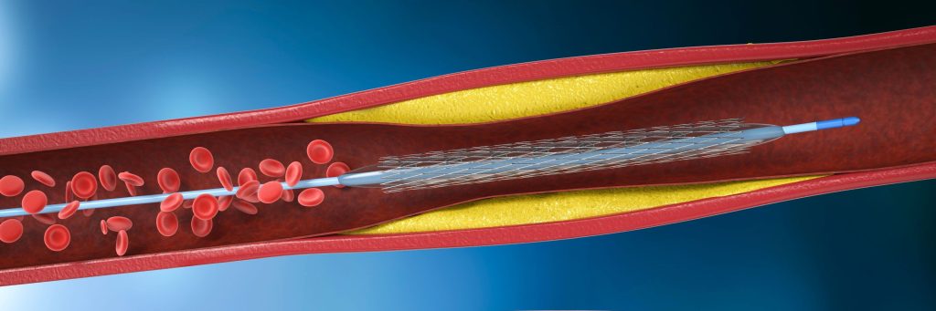3d rendering balloon angioplasty procedure with stent in vein, percutaneous coronary intervention